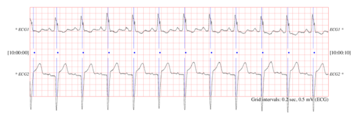 Figura 1. Muestra de electrocardiogramas de ECG5000. Fuente.