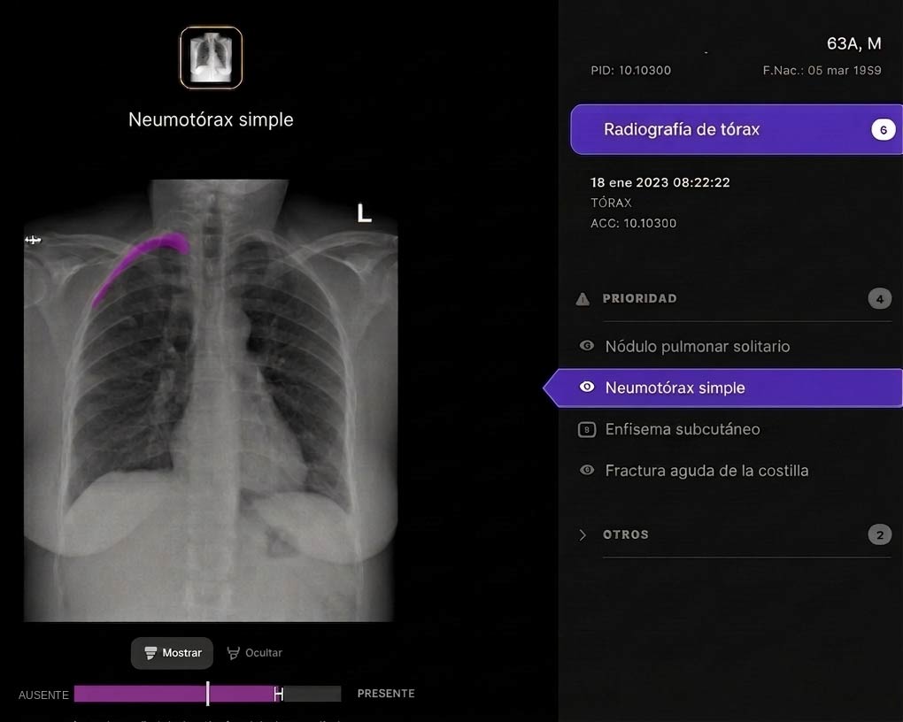 Visualización de resultados del algoritmo sobre una radiografía de tórax en el visor de la solución (los datos son simulados)